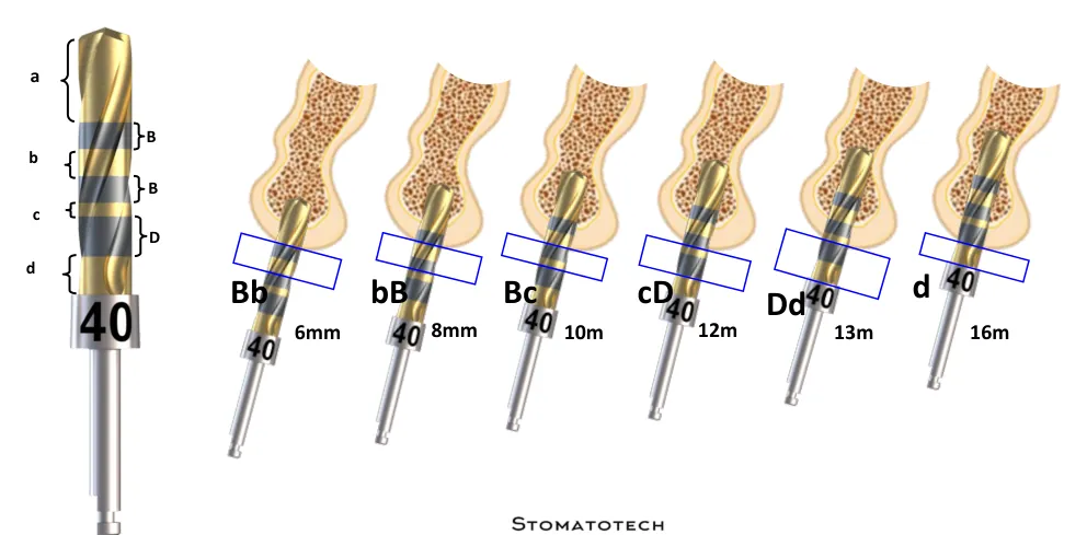 Crown Down drill depth marking code with letter markers a, B, b, c, and d corresponding to 6 mm, 8 mm, 10 mm, 12 mm, 13 mm, and 16 mm working depths in bone.