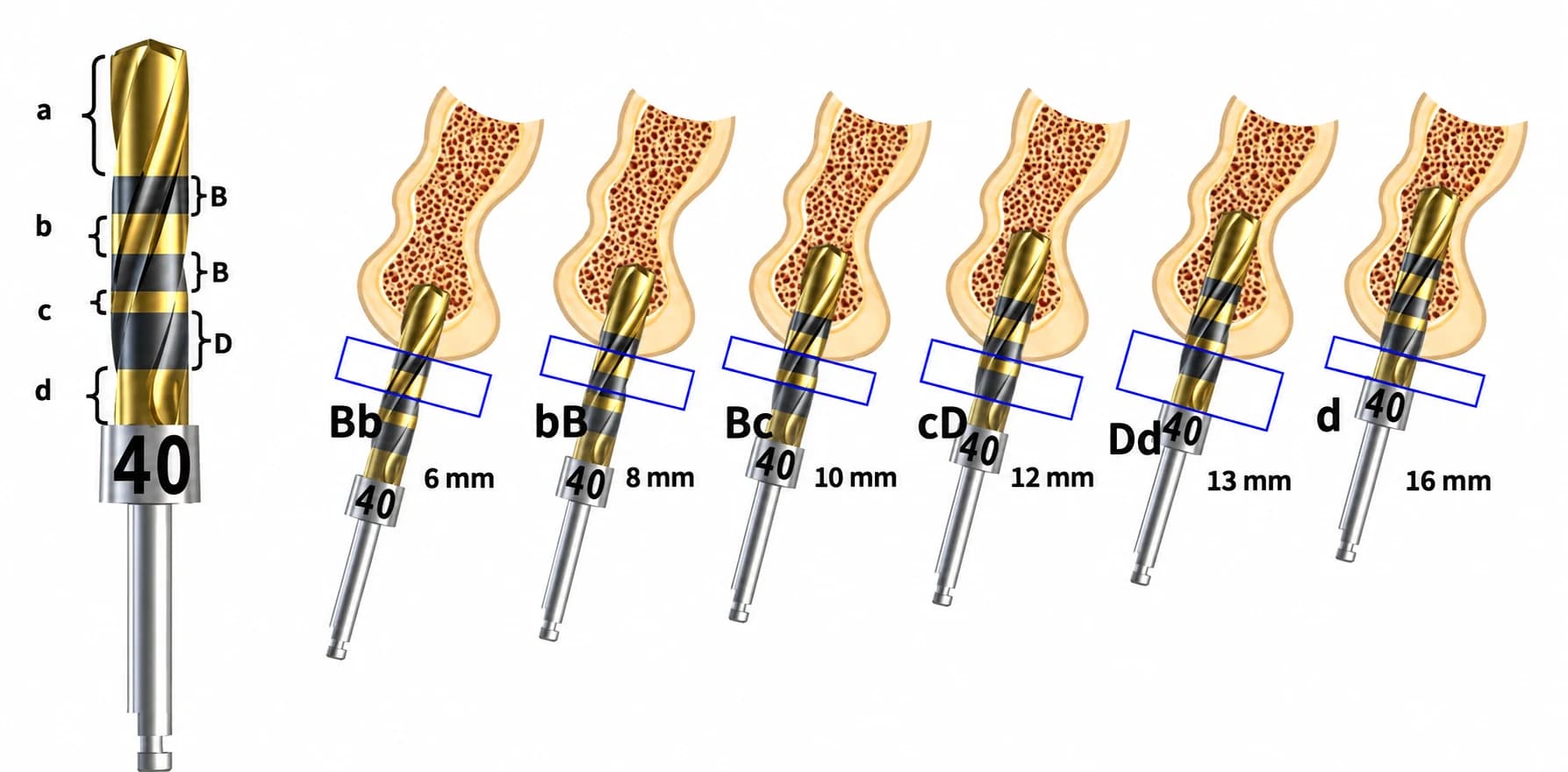 Crown Down drill depth marking code: laser-marked letter code (a, B, b, c, d) mapped to 6, 8, 10, 12, 13, and 16 mm working depths, with anatomical cross-sections showing how each marker aligns with cortical and trabecular bone during osteotomy preparation.