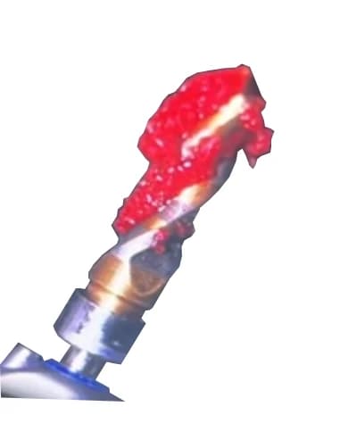 Autogenous bone chips collected on the flutes of a large-diameter Crown Down tungsten carbide implant drill during dry, low-speed osteotomy preparation, ready for immediate placement into the same surgical site.