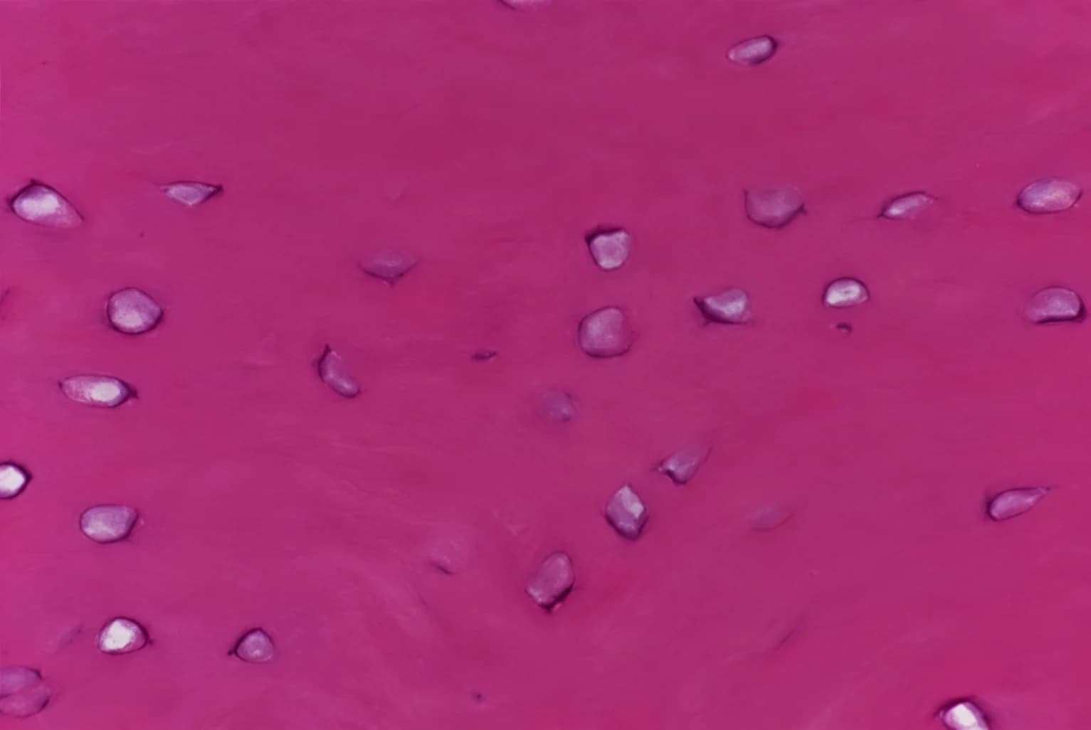 Illustrative histology of bone with empty osteocyte lacunae and loss of cellular detail, features consistent with thermal injury and bone necrosis.