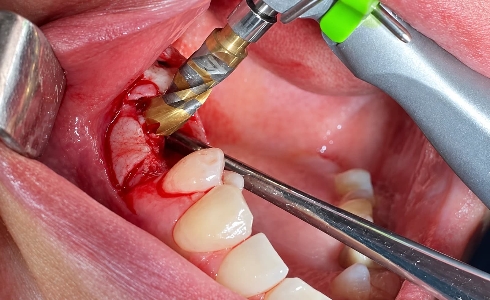 Crown Down tungsten carbide implant drill preparing the osteotomy site in a live surgical case, with the titanium-nitride cutting flutes and depth-stopper collar visible during intra-oral drilling.