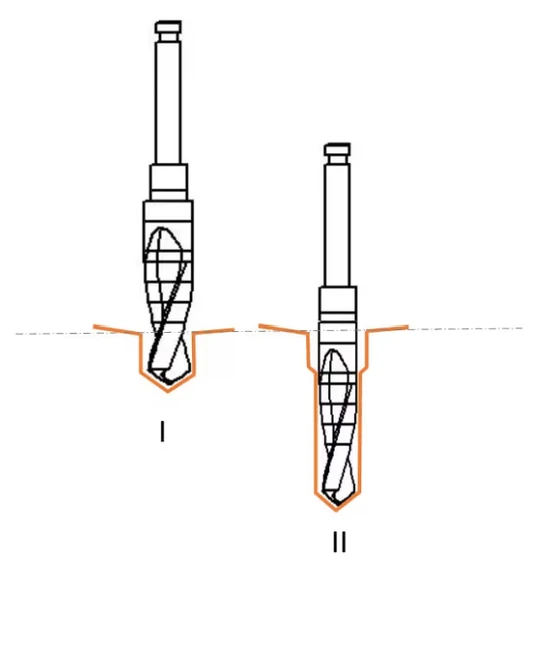 Crown Down drilling technique diagram: drill I clears the cortical bone with the wider working tip; drill II prepares the deeper trabecular portion with the narrower tip for controlled undersized drilling.