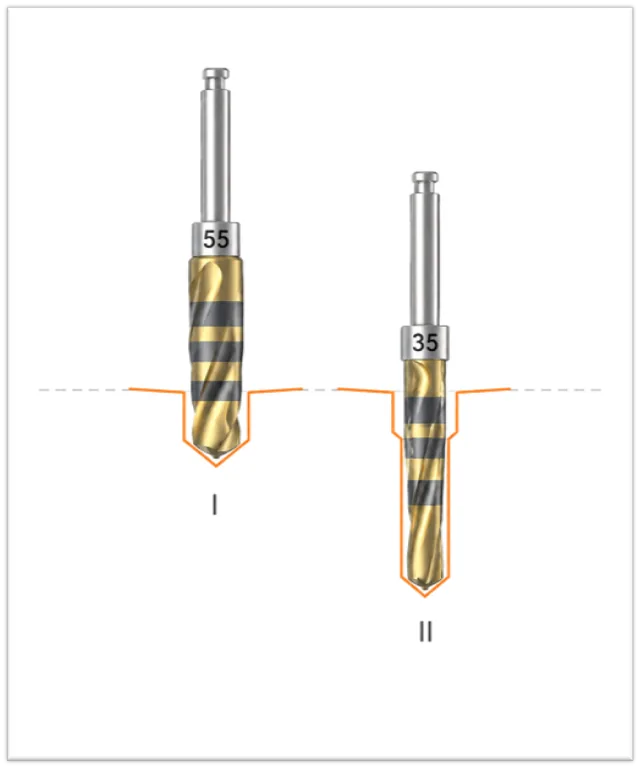 Crown Down 2-drill method diagram: drill I (cortical, #55 wider working tip) clears the cortical plate; drill II (trabecular, #35 narrower tip) prepares the deeper trabecular portion for controlled undersized osseocompression.