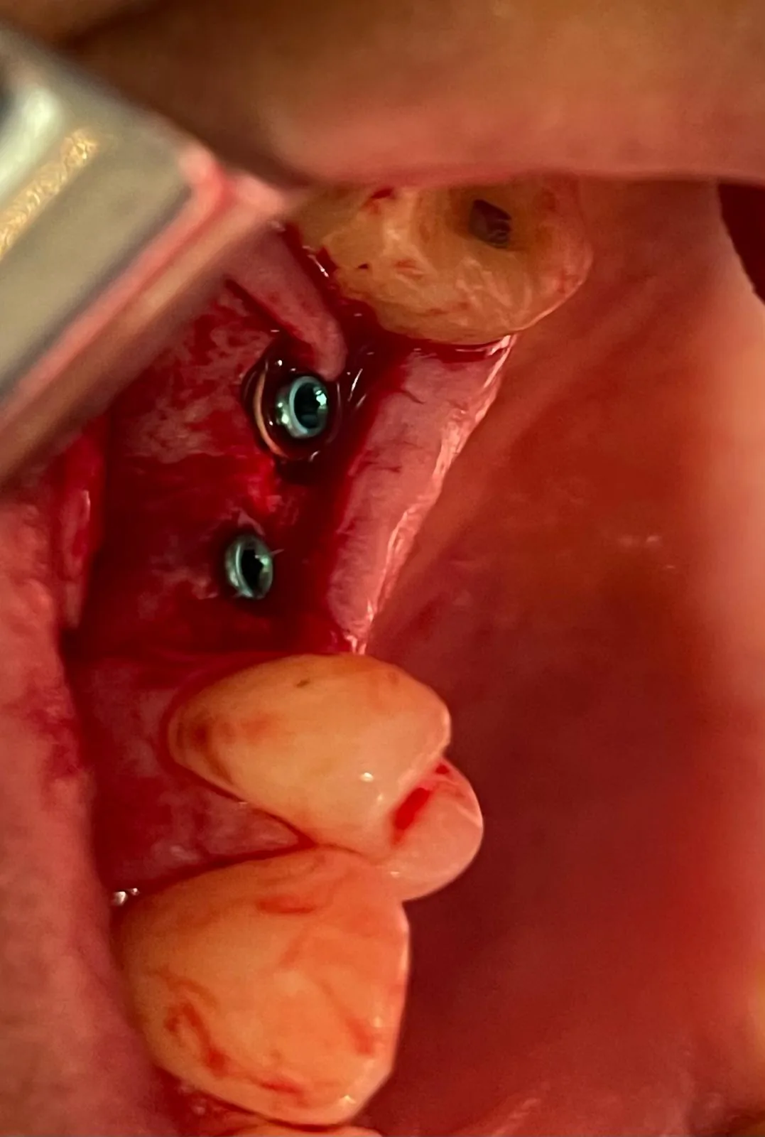 Occlusal intra-oral view of two adjacent implants placed at upper left #25 and #26 with cover screws in position