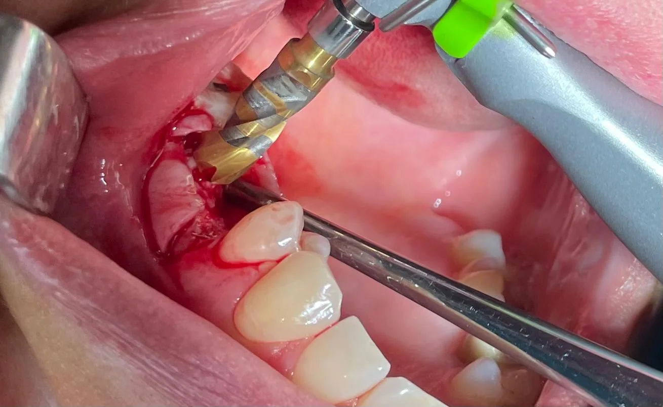 Intra-oral clinical view of the Crown Down cortical drill entering the upper left premolar crest through a retracted tissue flap, prepared without external saline irrigation