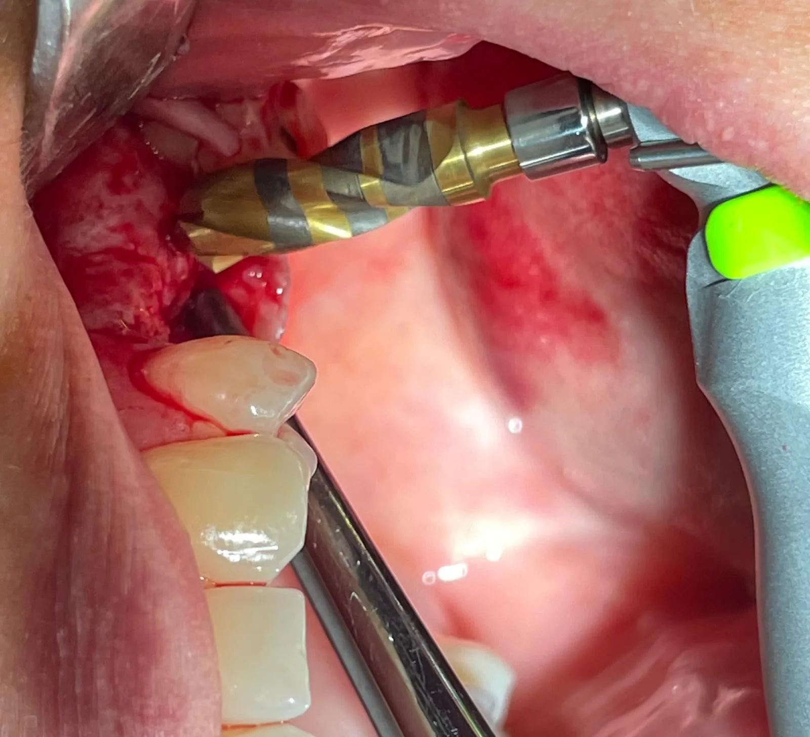 Second intra-oral angle of the Crown Down cortical drill advancing into the upper left #25 osteotomy at low speed, dry drilling