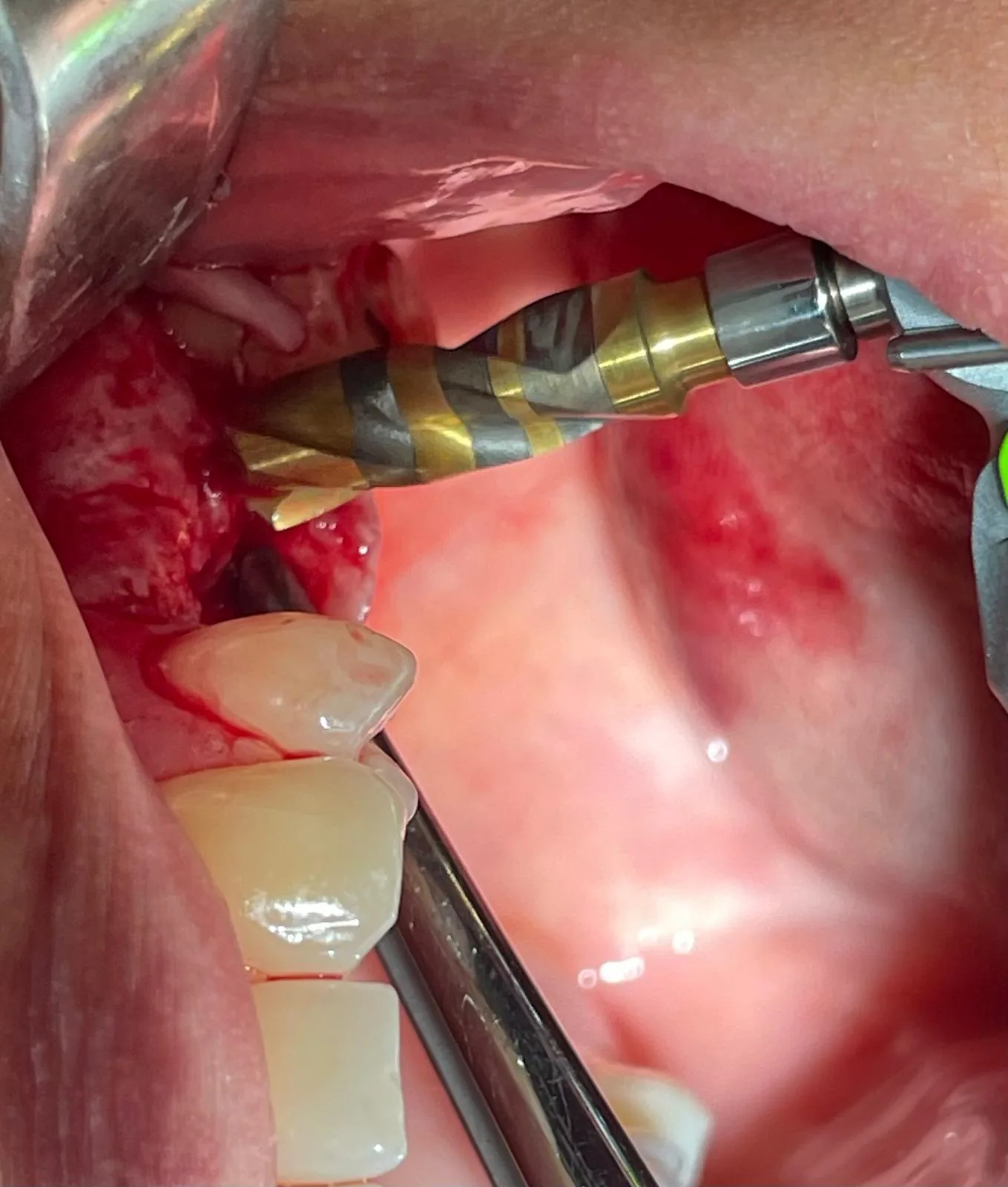 Third intra-oral angle showing the Crown Down drill deeper in the upper left #25 site with the tissue flap retracted