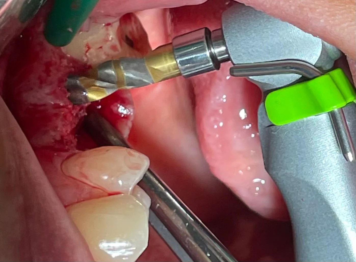 Intra-oral view of the Crown Down drill preparing the second osteotomy at upper left first molar #26, adjacent to the completed #25 site