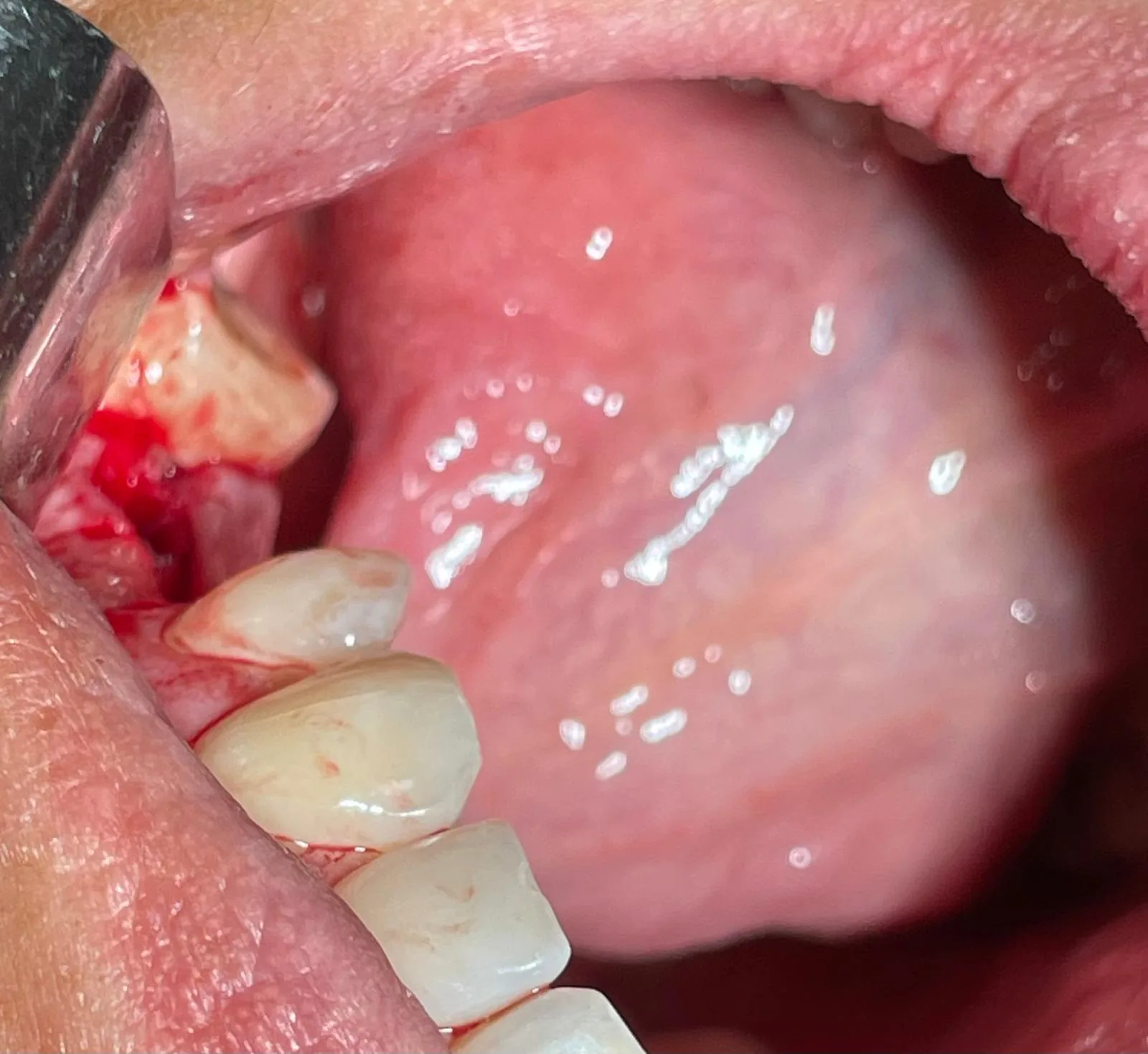 Occlusal intra-oral view of the retracted flap showing the prepared alveolar bed at upper left #25 and #26 before implant placement