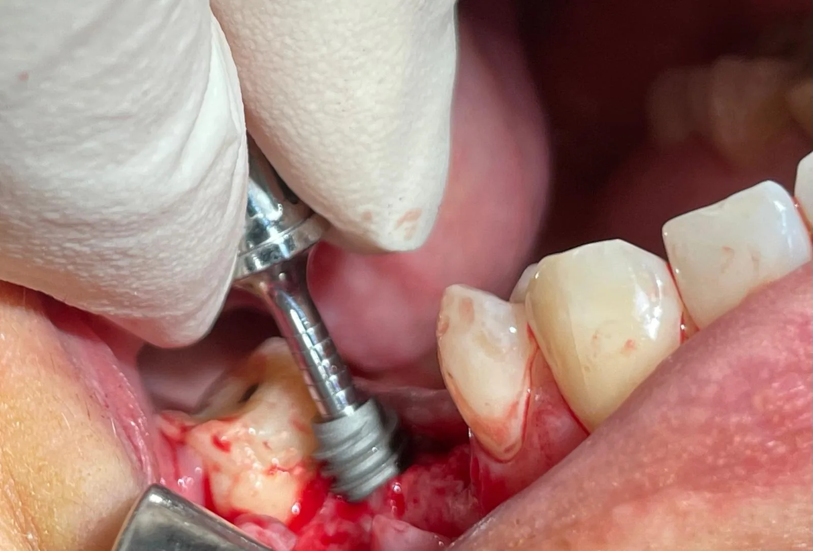 Intra-oral view of the implant being seated at upper left premolar #25 with the delivery driver engaged and the surrounding alveolus prepared