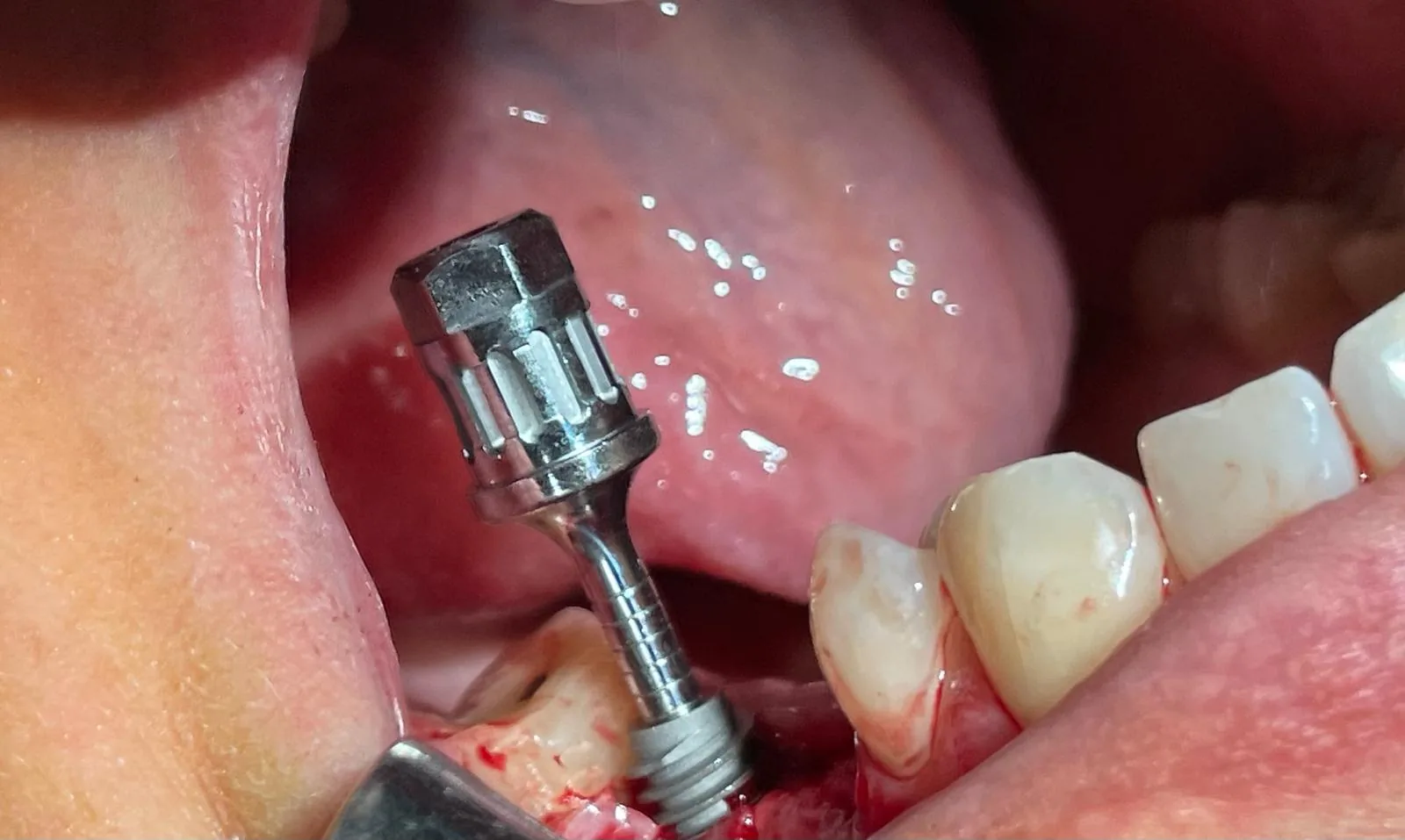 Second angle of the implant fully seated at upper left #25 with the driver hex adapter still visible above the platform