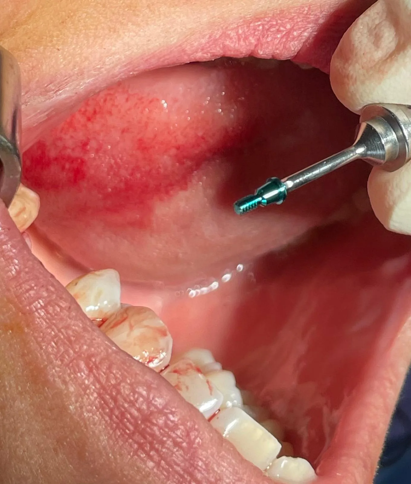 Cover screw mounted on the placement driver approaching the seated implant at upper left first molar #26