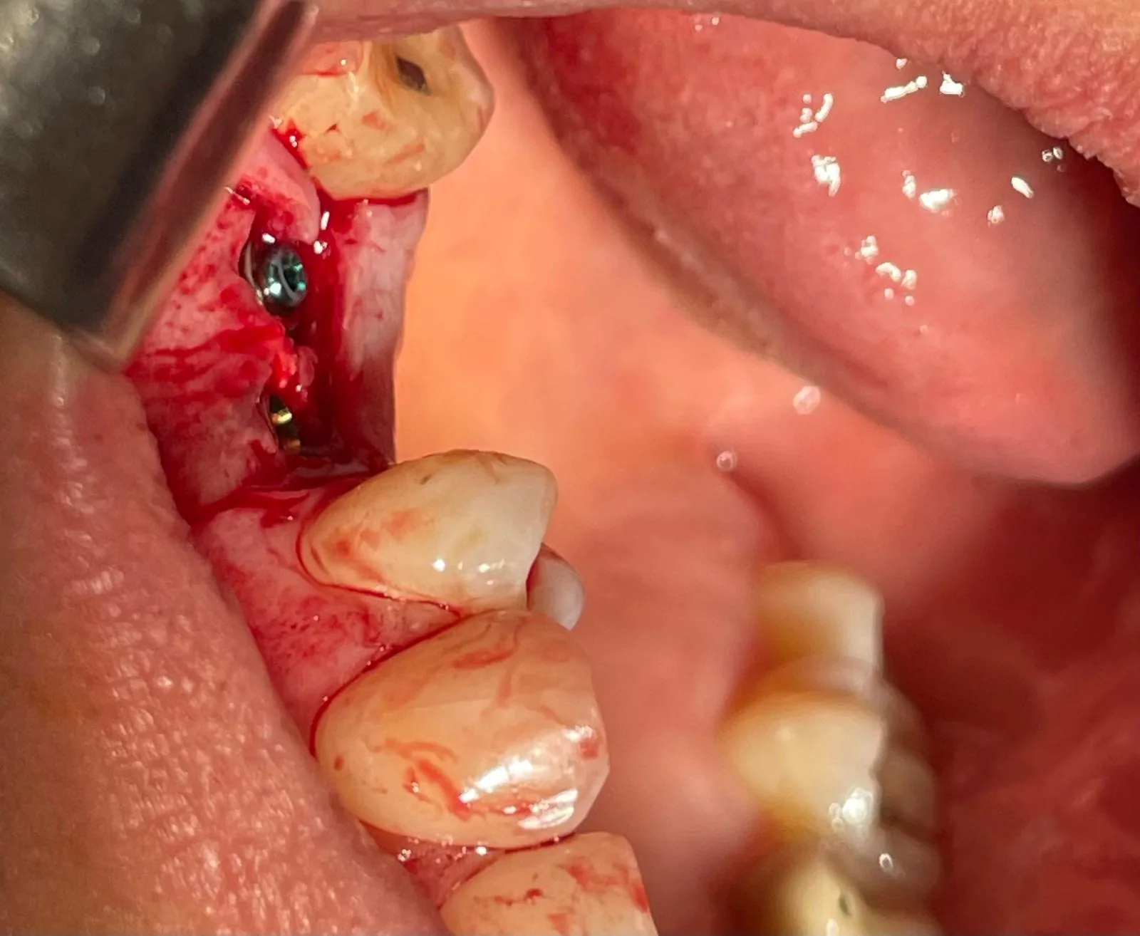 Intra-oral view of the anodized cover screw seated on the implant at upper left #26 with peri-implant tissue visible