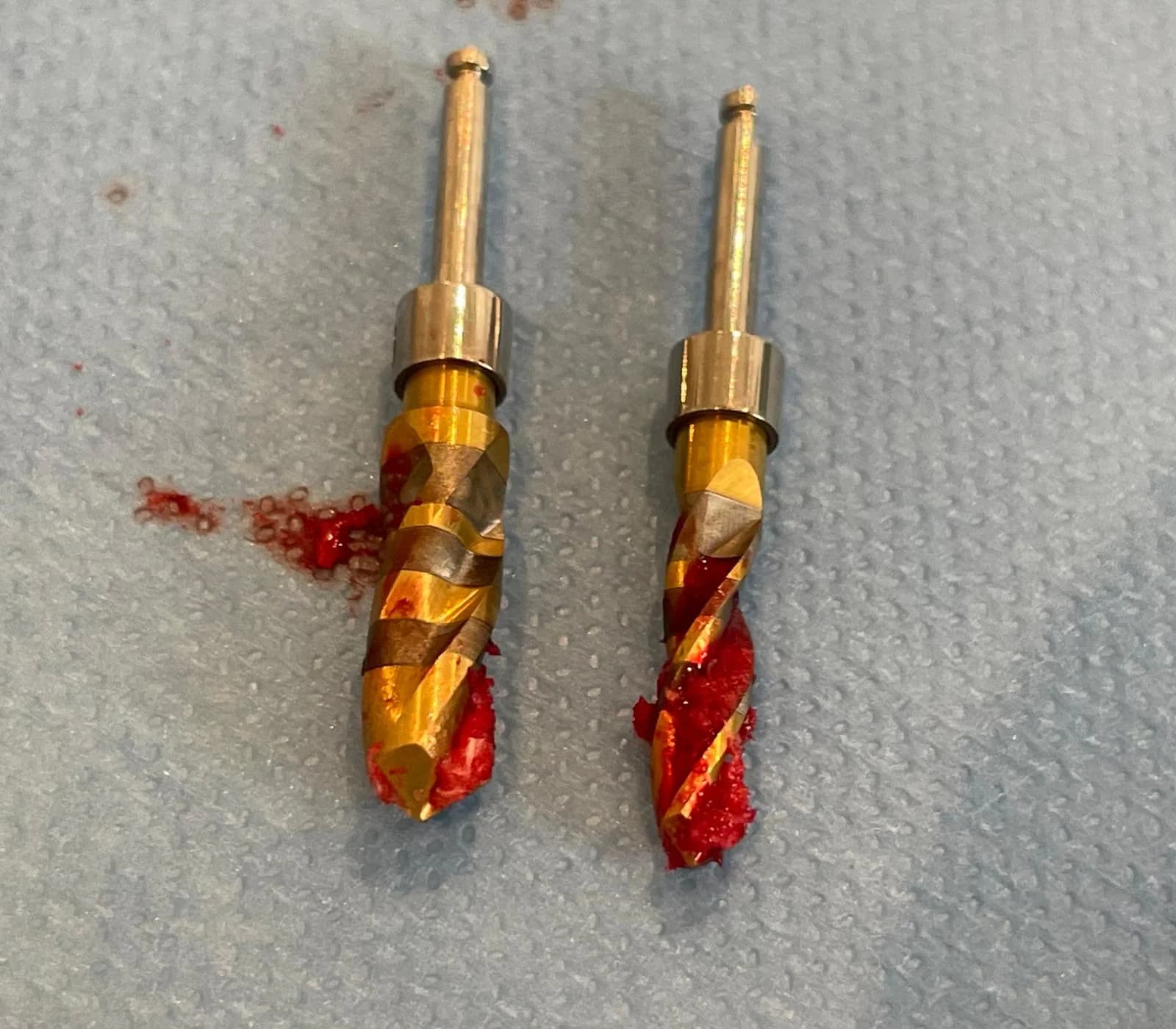 Two Crown Down tungsten carbide implant drills side by side after preparing both osteotomies at #25 and #26, with autogenous bone particles and blood still visible on the flutes from the dry drilling pass
