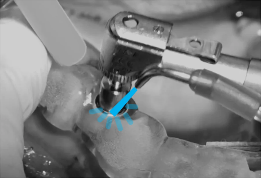 Low-speed dental implant osteotomy preparation with a solid tungsten carbide Crown Down drill, performed without saline irrigation because the thermal conductivity of tungsten carbide removes the heat threshold problem at its source.