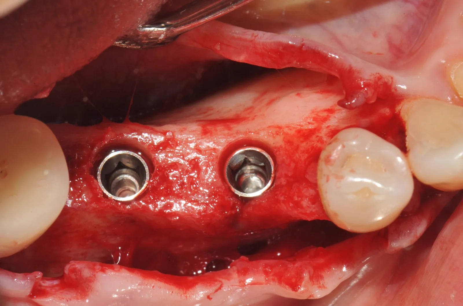 Open flap clinical view of two dental implants placed in the mandibular ridge using the Crown Down 2-drill method, with stable primary fixation in trabecular bone.