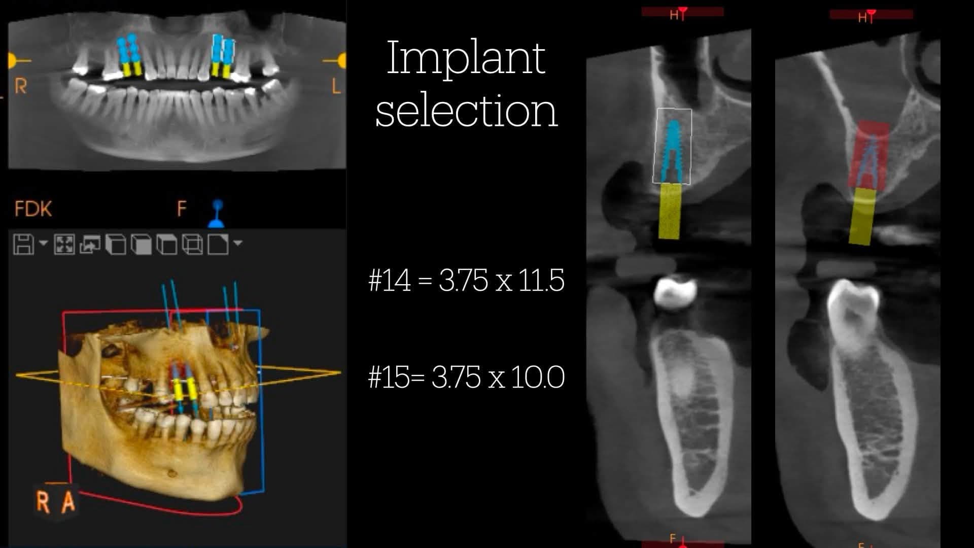 CBCT planning with panoramic reconstruction, 3D model and two sagittal slices for implants #14 and #15, sized 3.75 x 11.5 mm and 3.75 x 10.0 mm