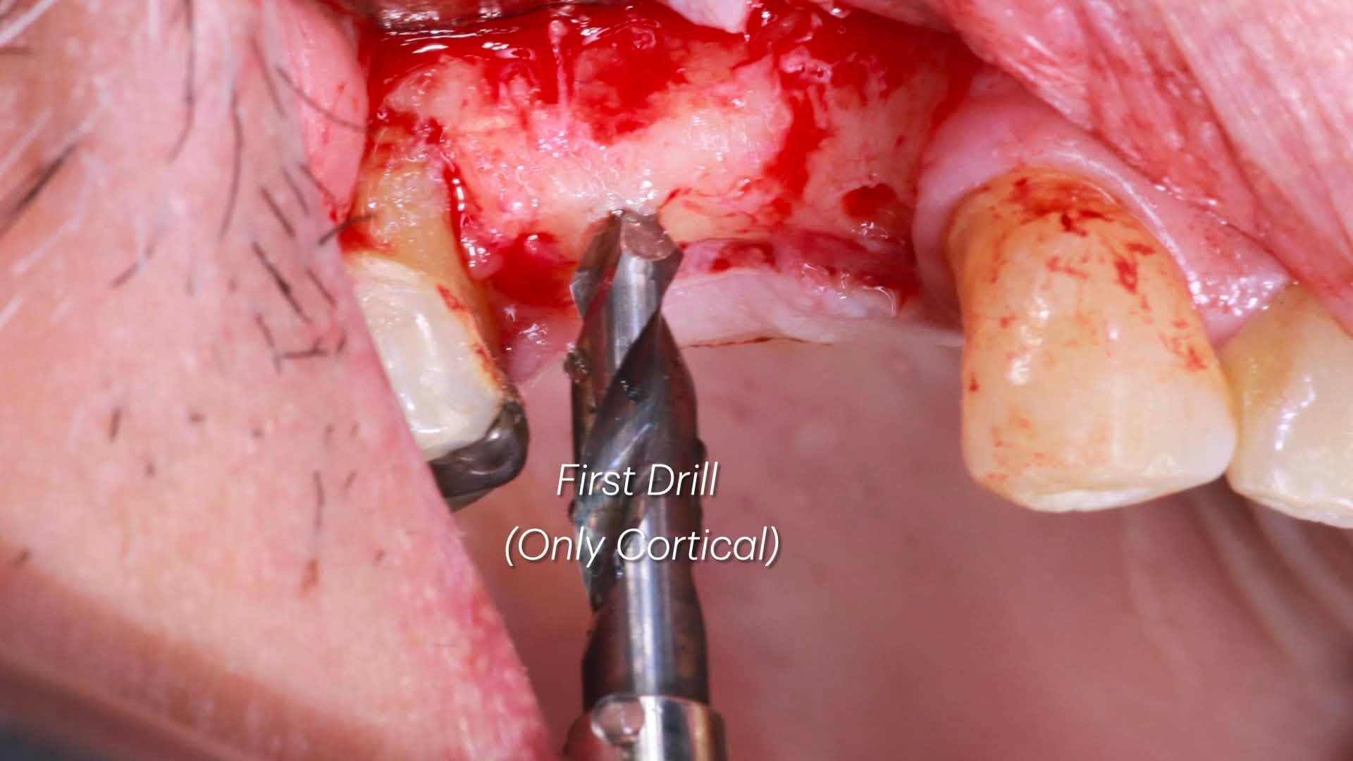 Intra-oral clinical view of the Crown Down cortical drill entering the upper right premolar crest through the surgical flap