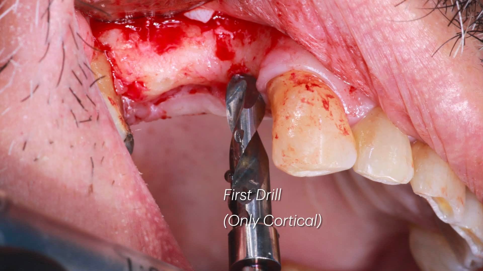 Second intra-oral angle showing the Crown Down cortical drill engaged in the crest of the adjacent upper right premolar site