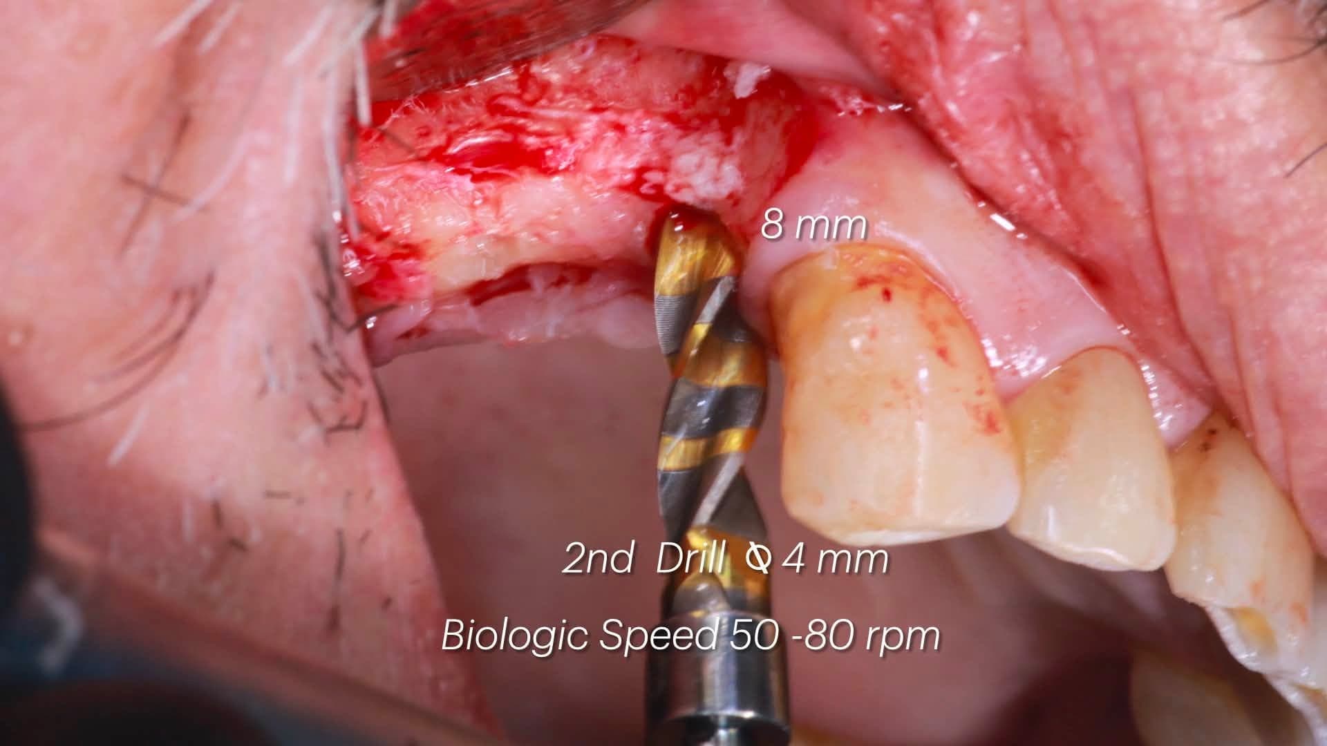 Intra-oral view of the second Crown Down drill advancing the osteotomy to 8 mm at biologic speed 50-80 rpm