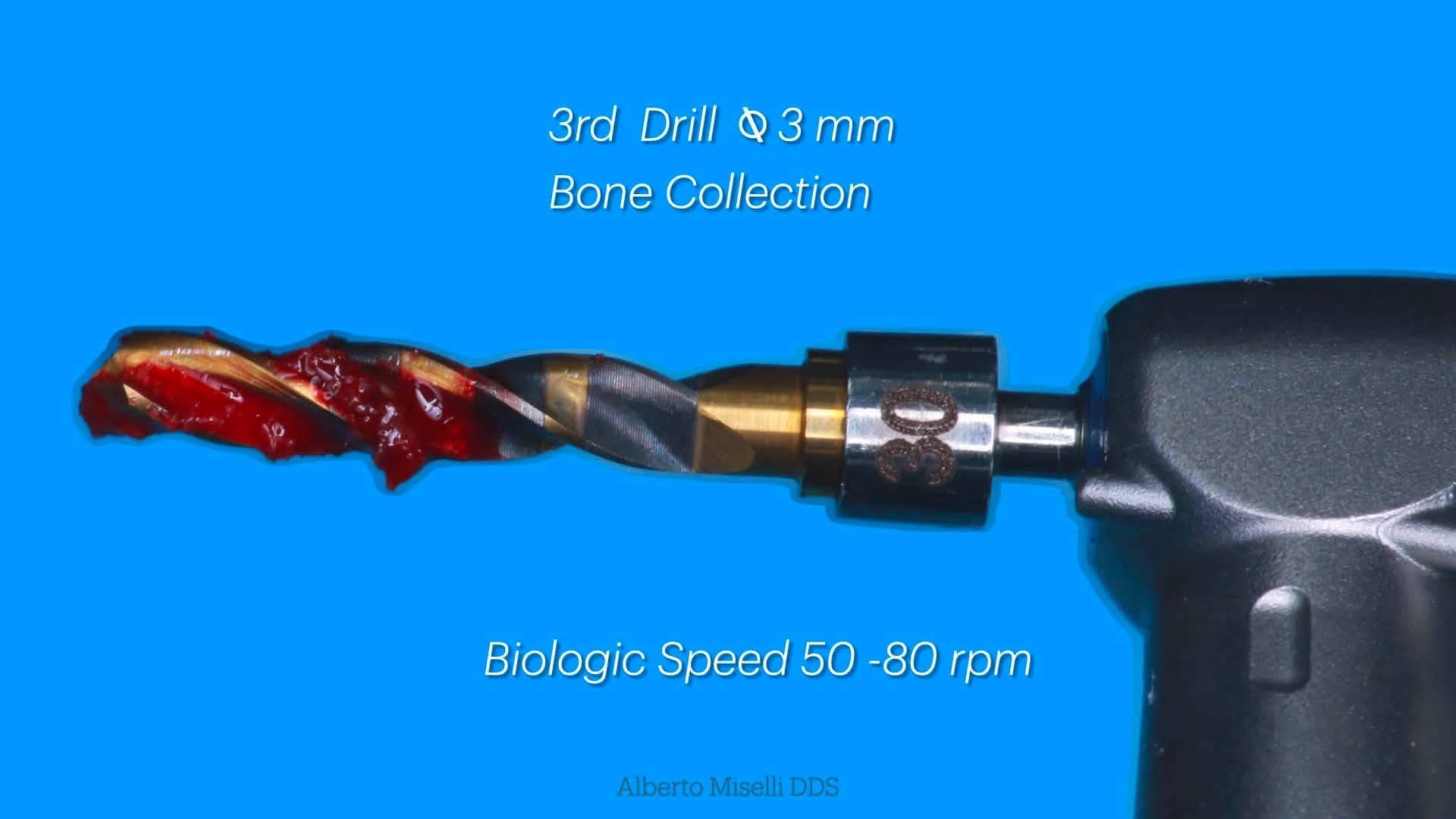 Third Crown Down drill, Ø 3 mm, shown with autogenous bone chips gathered on its flutes after low-speed drilling at 50-80 rpm
