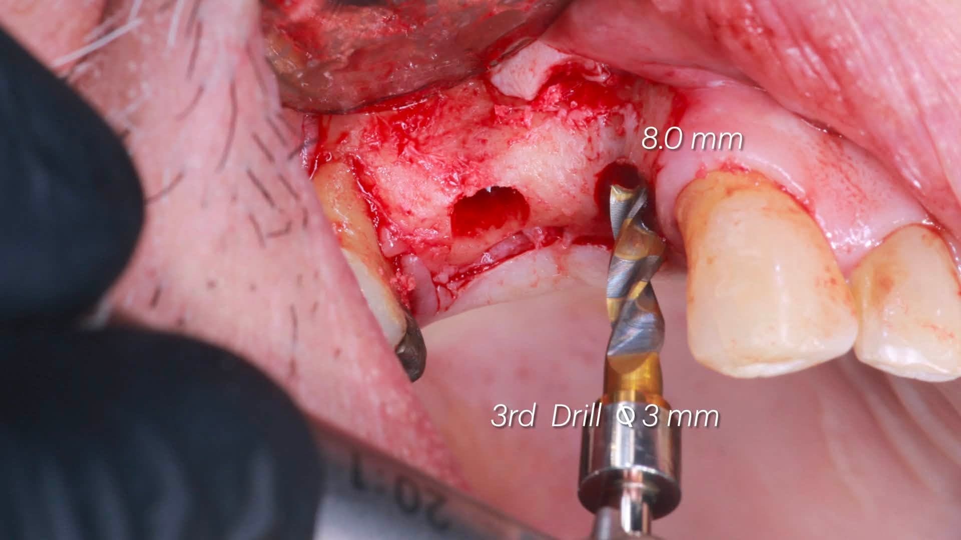 Intra-oral view of the third Crown Down drill inside the 8 mm osteotomy at biologic speed, collecting autogenous bone during preparation