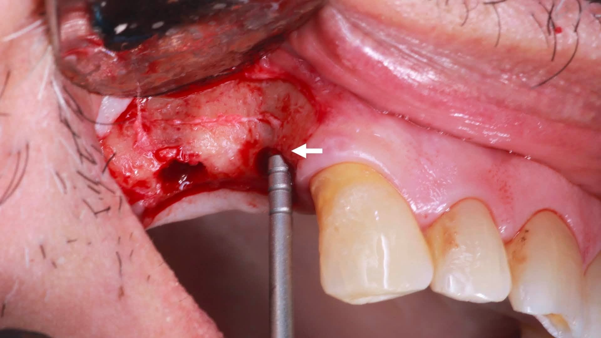 Depth probe positioned at the crest of the prepared osteotomy to confirm the target implant depth