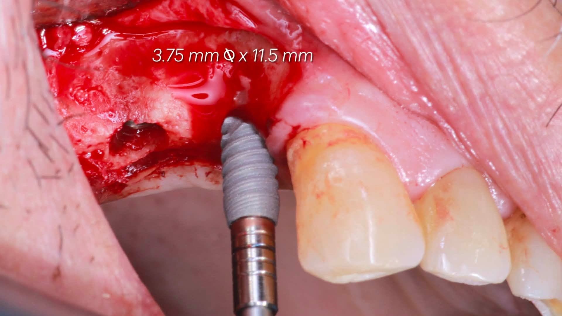 Intra-oral view of the 3.75 x 11.5 mm implant being seated into the prepared upper right #14 osteotomy