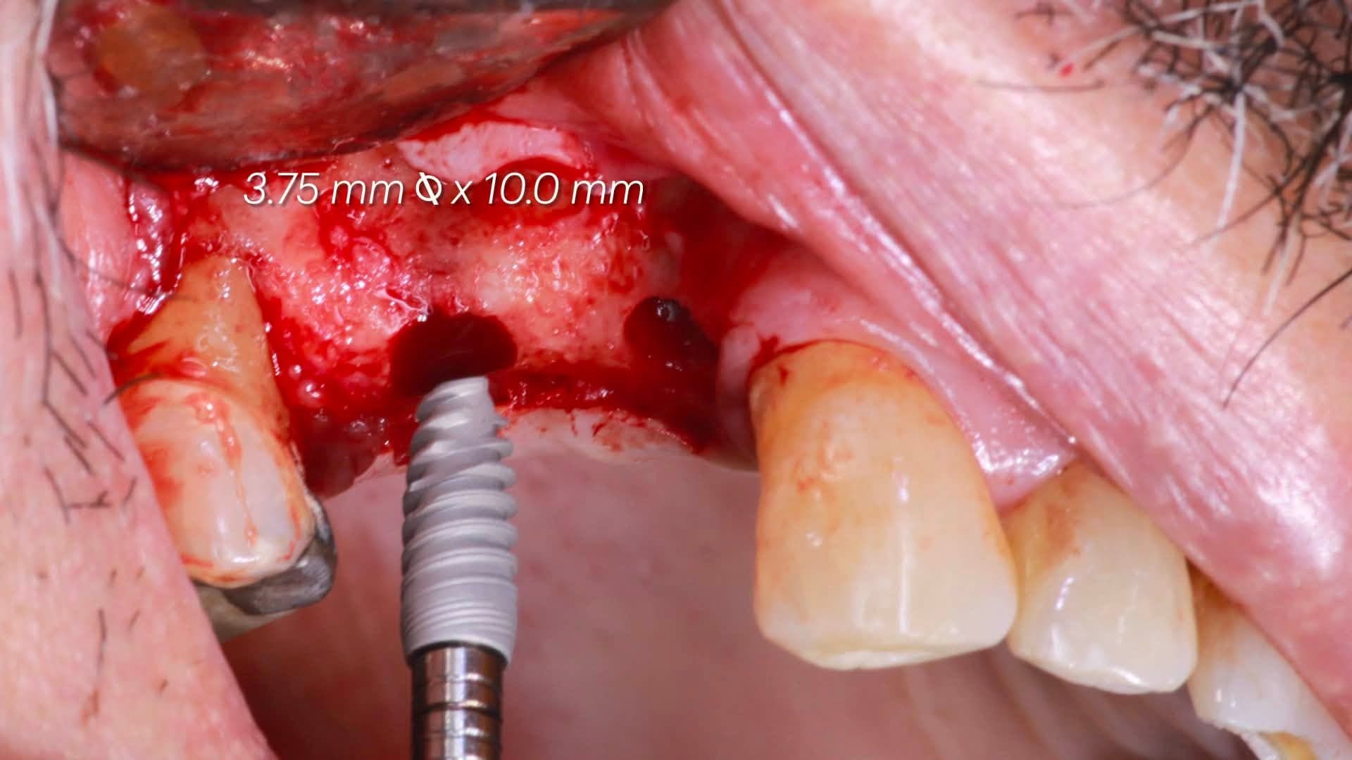 Intra-oral view of the 3.75 x 10.0 mm implant being seated into the adjacent upper right #15 osteotomy