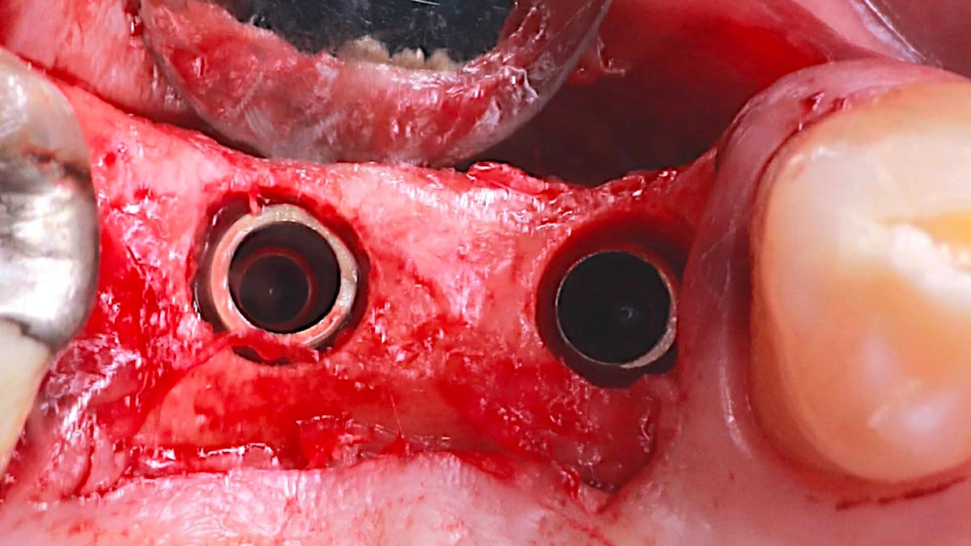 Occlusal intra-oral view of two adjacent implants placed at upper right #14 and #15 with cover screws in position