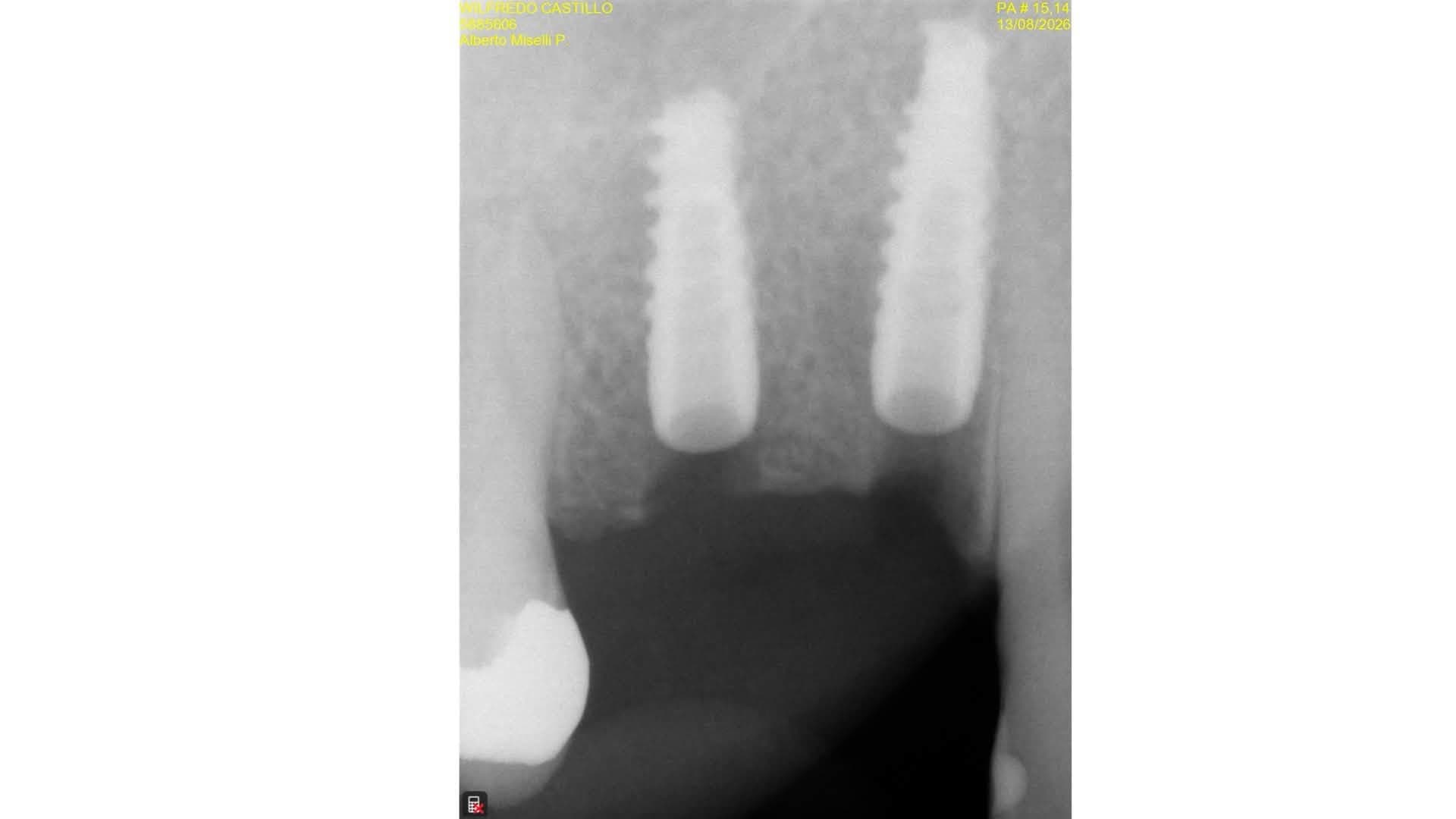 Post-operative periapical radiograph of two adjacent implants at upper right #14 and #15 confirming depth and angulation