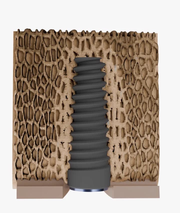 Cross-section of trabecular bone after osseocompression: implant macrogeometry mechanically condenses the surrounding trabecular bone without bone-chip compaction.