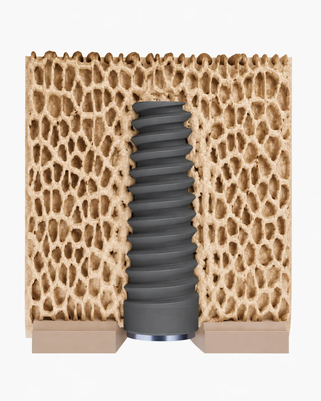 Cross-section of trabecular bone after osseocompression: implant macrogeometry mechanically condenses the surrounding trabecular bone without bone-chip compaction.