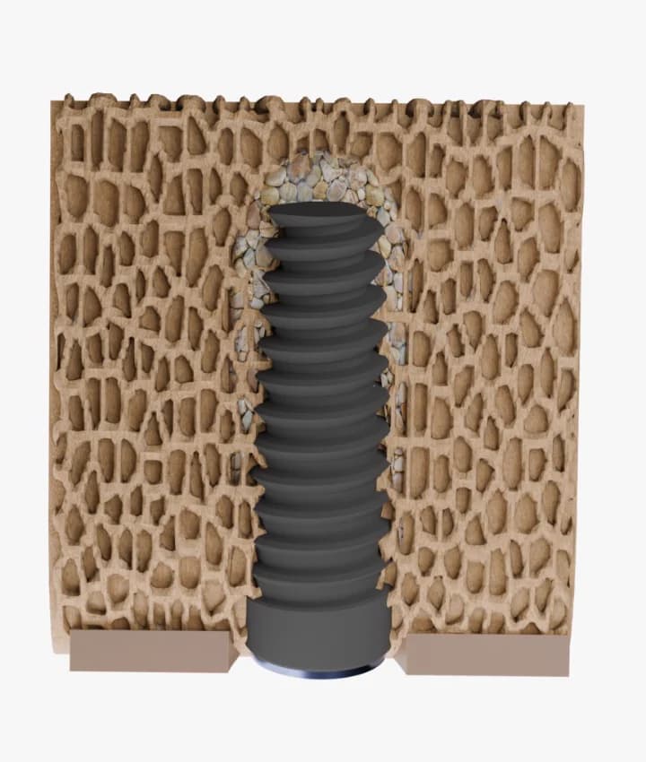 Cross-section of trabecular bone after osseodensification: autogenous bone chips compacted laterally and apically around the implant body.