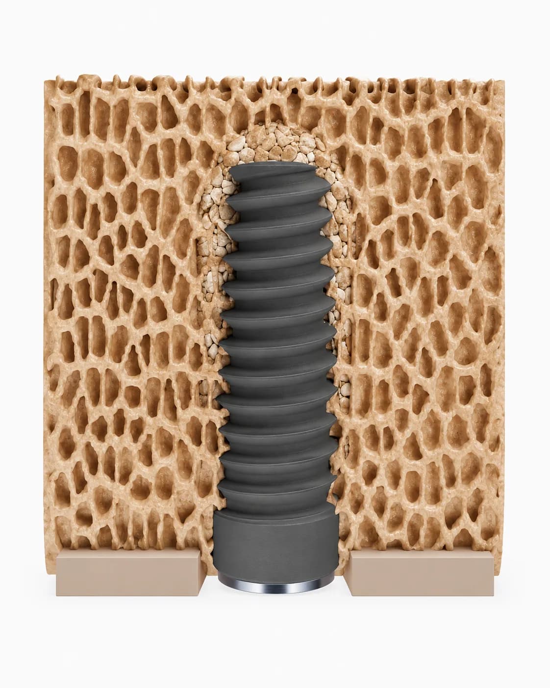Cross-section of trabecular bone after osseodensification: autogenous bone chips compacted laterally and apically around the implant body.