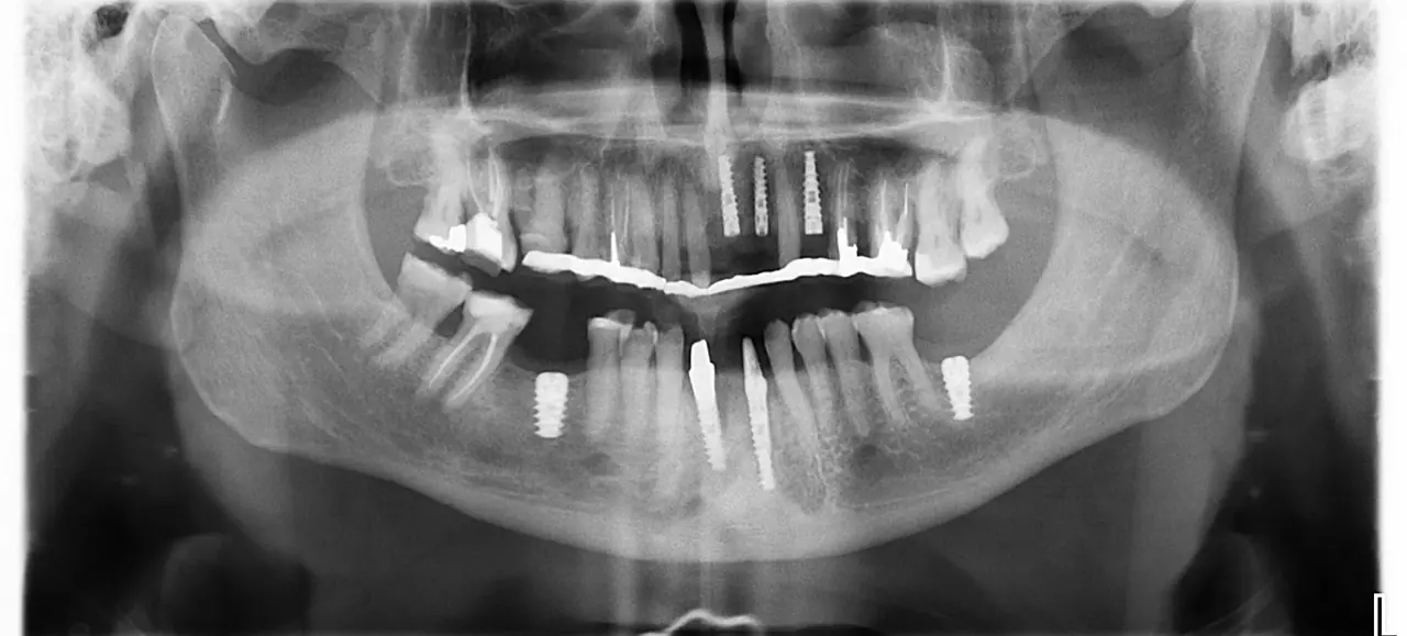 Osteotomy site after Crown Down 2-drill protocol, showing clean walls and preserved bone vitality