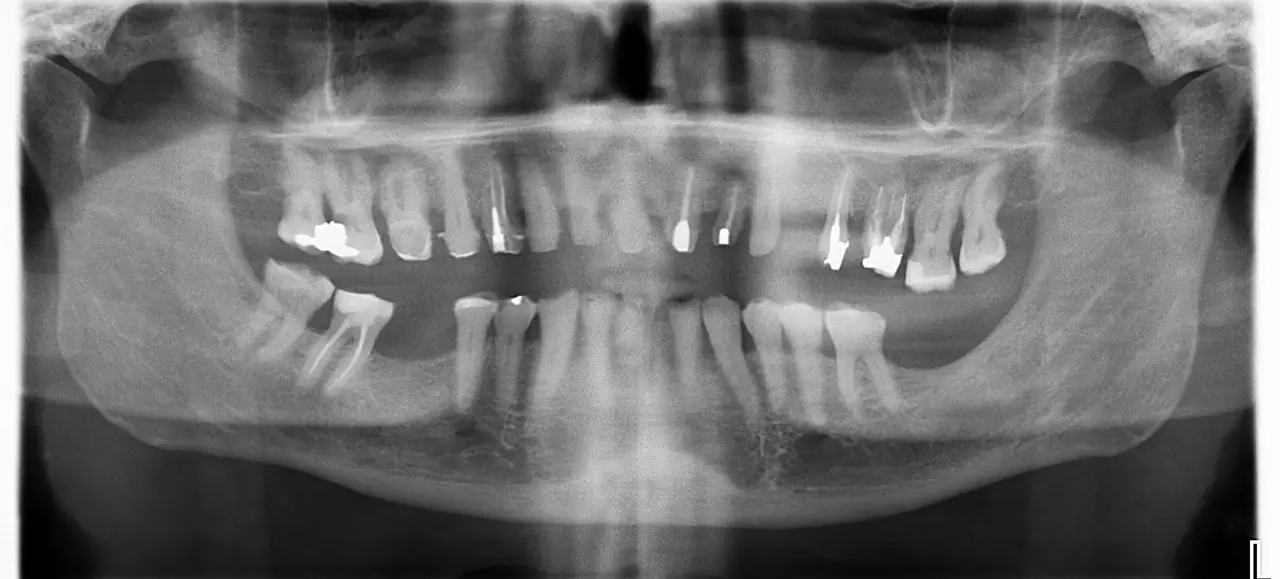 Osteotomy site after conventional drilling, showing rough walls and bone debris