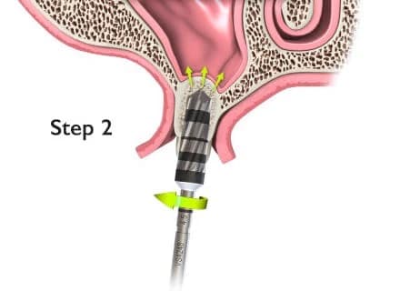 Versah Densah bur in counter-clockwise osseodensification protocol, compacting bone chips laterally and apically into the implant osteotomy walls.